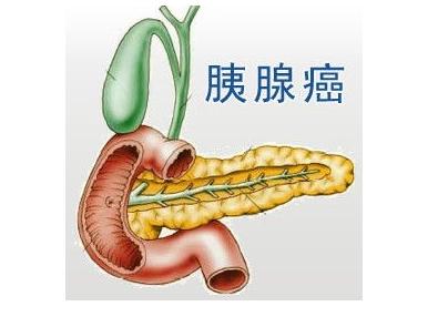 美国冷泉港实验室科学家利用胰腺癌的成瘾性来开发新型抗癌疗法