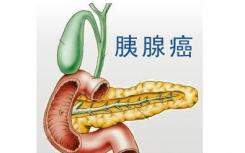 美国冷泉港实验室科学家利用胰腺癌的成瘾性来开发新型抗癌疗法