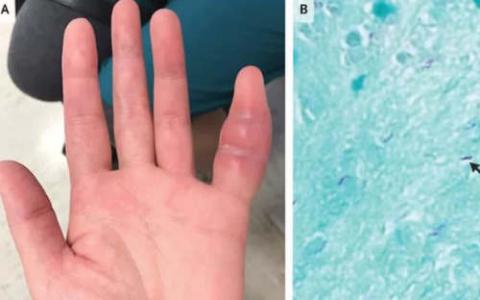 女人的肿胀小指手指是罕见的结核病的迹象