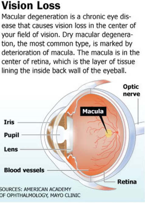 黄斑变性：症状 诊断和治疗