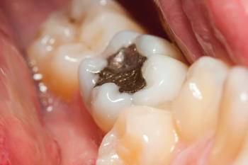 新的牙釉质图谱揭示了人类牙齿的确切成分