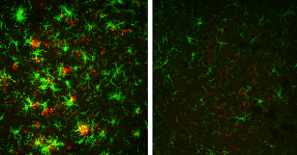 切断脑酶会逆转小鼠的阿尔茨海默氏症斑块
