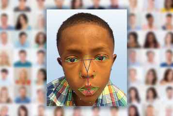 面部识别软件有助于诊断罕见的遗传病