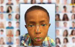 面部识别软件有助于诊断罕见的遗传病
