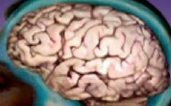创伤性脑损伤手术可能会导致后期危害