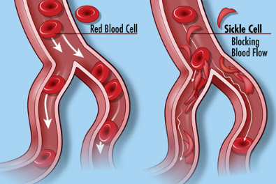 新的NIH研究寻求受镰状细胞病 性状影响的成年人和家庭