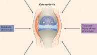 研究人员确定了9个骨关节炎新基因