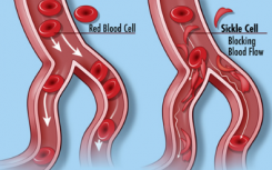 新的NIH研究寻求受镰状细胞病 性状影响的成年人和家庭