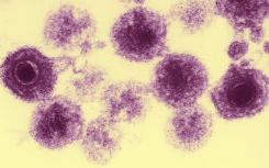 科学家在阿尔茨海默病患者脑中发现高水平的两种疱疹病毒株