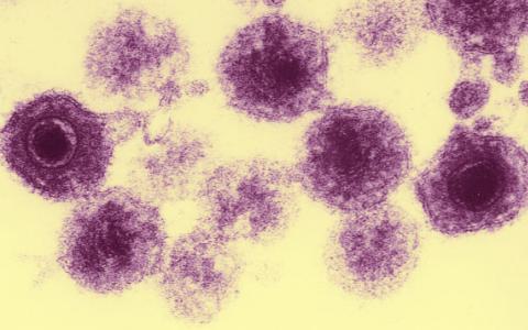 科学家在阿尔茨海默病患者脑中发现高水平的两种疱疹病毒株