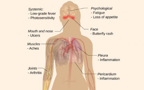 研究人员确定狼疮的潜在原因