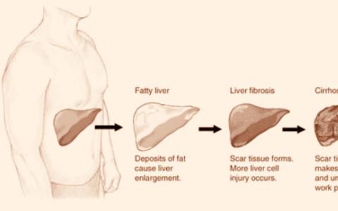 研究人员确定了导致肝纤维化的蛋白质