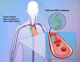 用DNA测序改进心脏移植排斥反应的检测