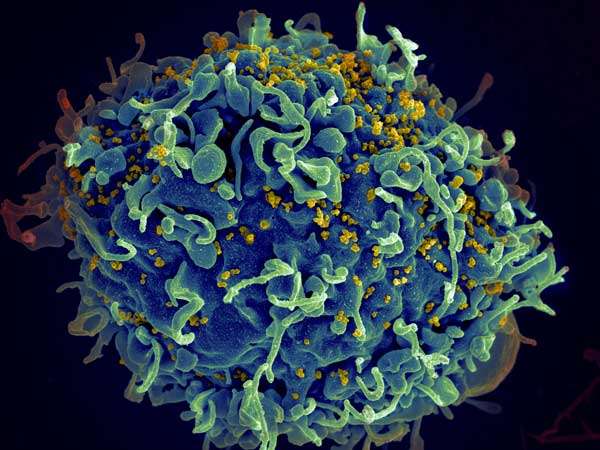 科学家们对HIV感染严重程度的遗传性提出了新的见解