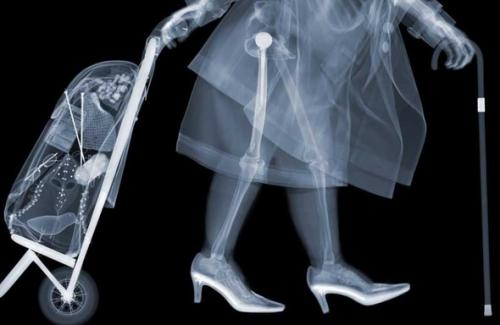 X射线肥胖患者所需的较高辐射剂量会增加癌症风险