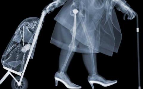 X射线肥胖患者所需的较高辐射剂量会增加癌症风险