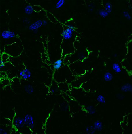 大脑的免疫细胞与阿尔茨海默氏症 帕金森症 精神分裂症有关