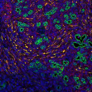 胰腺肿瘤依赖于周围细胞的信号