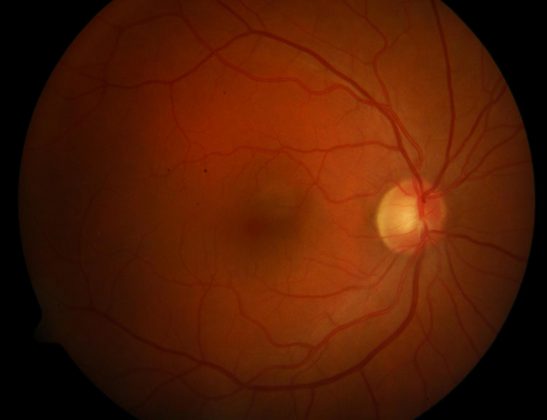 人工智能算法用于检测糖尿病眼病的关键体征之一