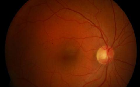 人工智能算法用于检测糖尿病眼病的关键体征之一