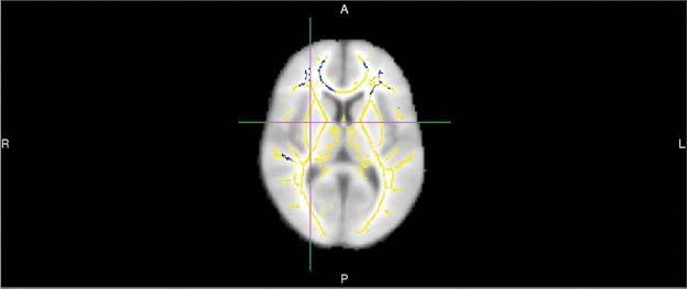 MRI对阿尔茨海默氏症的预测优于常规检查