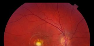 Ophthotech扩大了眼科疾病小分子 基因治疗候选管道