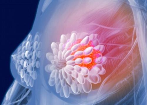 乳腺癌细胞外基质硬化促进恶性肿瘤