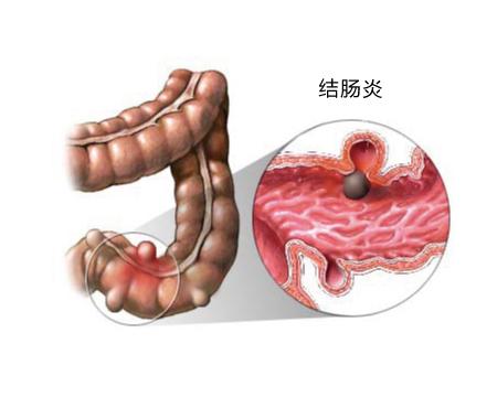 研究人员发现了控制粘液生成的蛋白质 提出了治疗结肠和气道疾病的线索