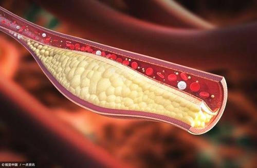 癌细胞在胆固醇中可能有致命的跟腱