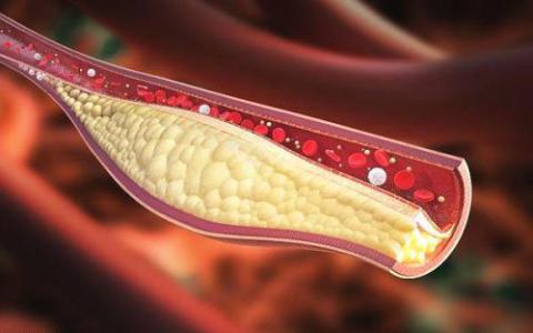癌细胞在胆固醇中可能有致命的跟腱