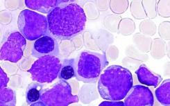 FDA对Xencor血癌抗体XmAb14045的试验实施部分临床控制
