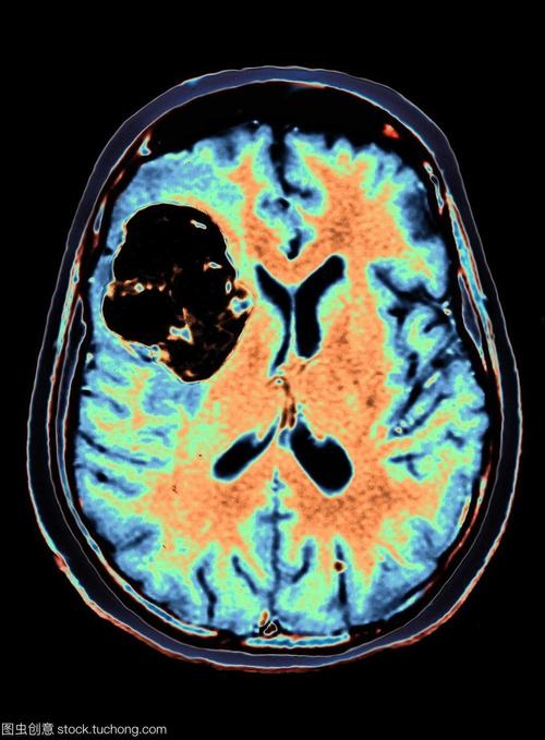 为什么大脑中的黑色素瘤可能更严重