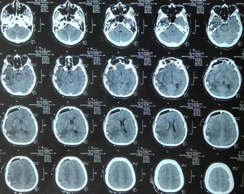 研究人员报告了治疗侵袭性脑肿瘤的进展