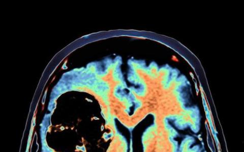 为什么大脑中的黑色素瘤可能更严重