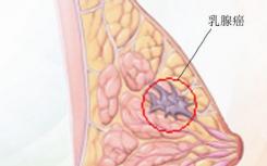 帮助乳腺癌患者降低化疗副作用