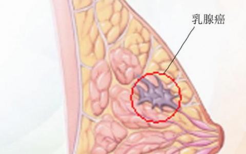 帮助乳腺癌患者降低化疗副作用