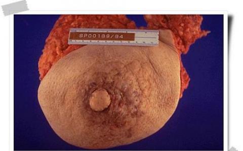 新型单抗leronlimab 6周将乳腺癌转移减少98%以上