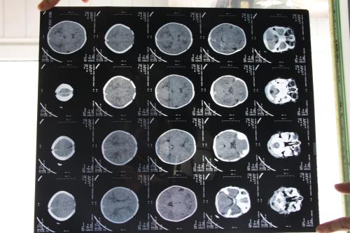 人工智能可识别九类急性脑CT异常