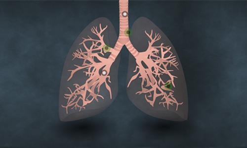 帮助肺癌患者选择最佳疗法 液体活检表现比肩组织活检