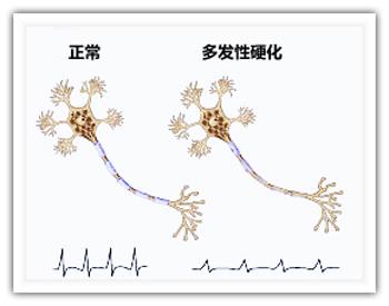 科学家发现治疗多发性硬化的新机制