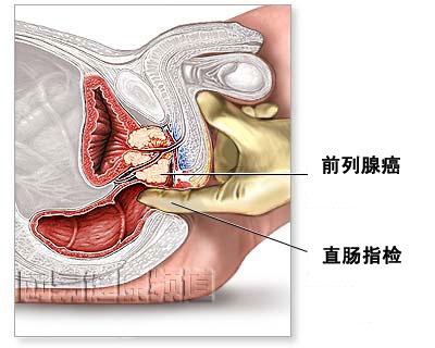 前列腺癌细胞是如何变得抵抗药物治疗的