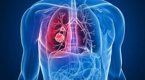 强生与AdoRx公司布局肺癌创新免疫疗法