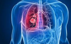 强生与AdoRx公司布局肺癌创新免疫疗法