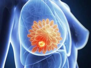 FDA批准Tecentriq-Abraxane Combo作为乳腺癌的首选免疫治疗方案