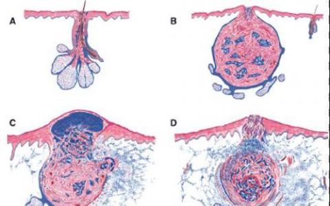 鼠标模型提供了对痤疮起源的洞察力