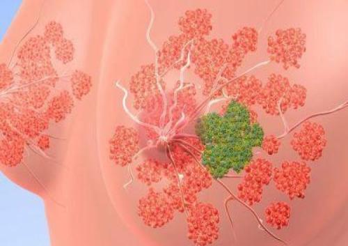 乳腺癌复发的动态显示晚期复发的ER阳性基因组亚组