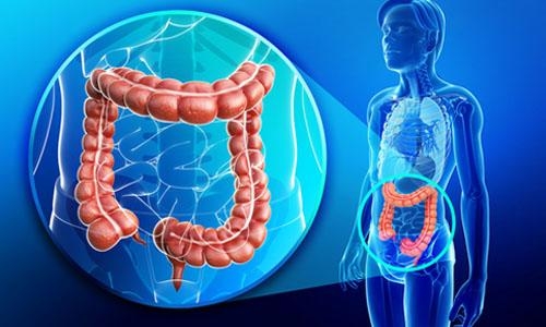 斑块引起的细菌显示促进结肠直肠癌