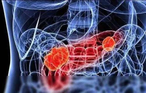 基因组学可以指导胰腺癌患者的治疗