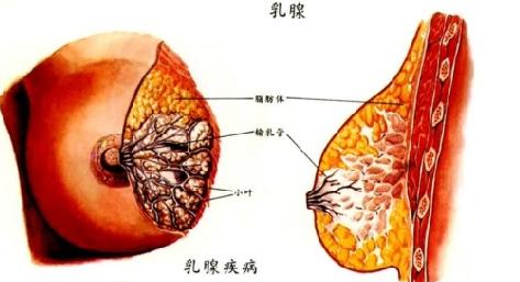 由糖皮质激素促进乳腺癌的传播