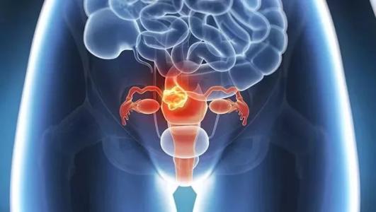 基于蛋白质组学的新测试可以帮助早期发现卵巢癌